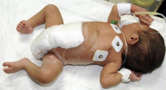 bebe de 6 pernas operado